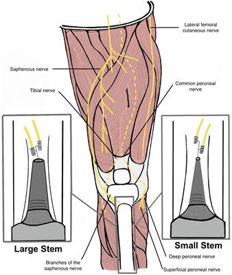 Clinical Basis for Creating an Osseointegrated Neural Interface